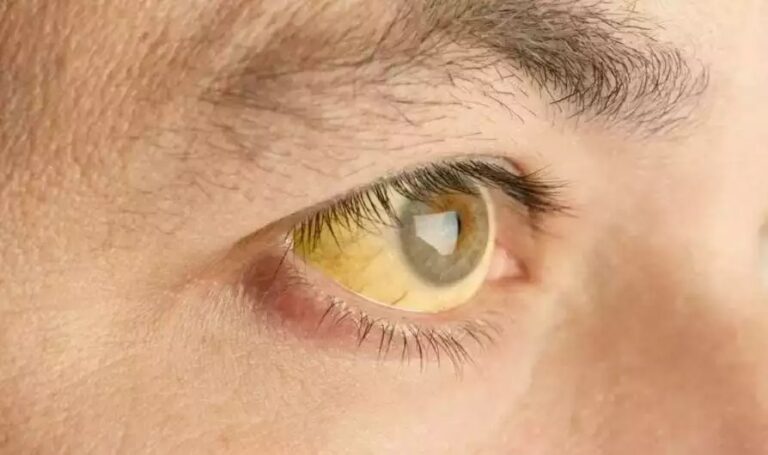 Jaundice